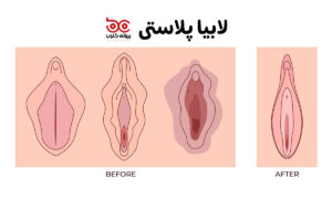 زیبایی واژن