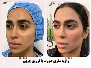 زاویه سازی صورت