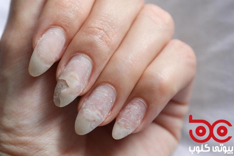Nail_Fungus