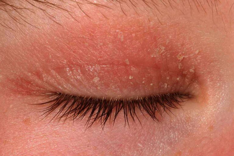 Eyelid dermatitis