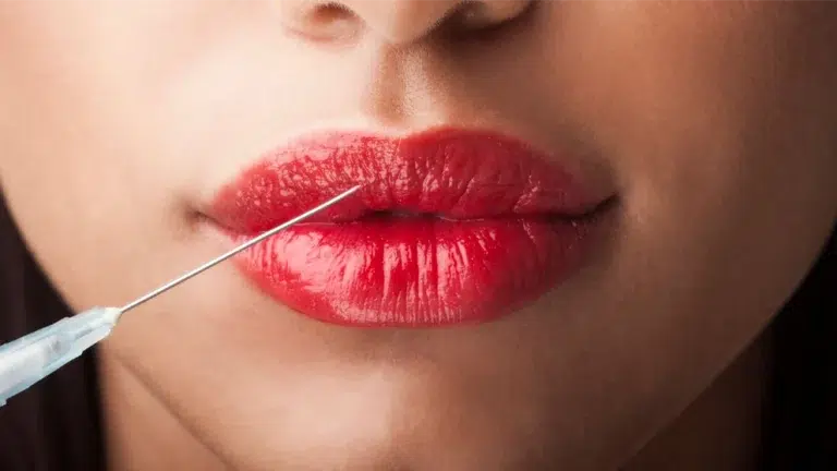 روش تزریق ژل لب سه دکمه ای چیست؟