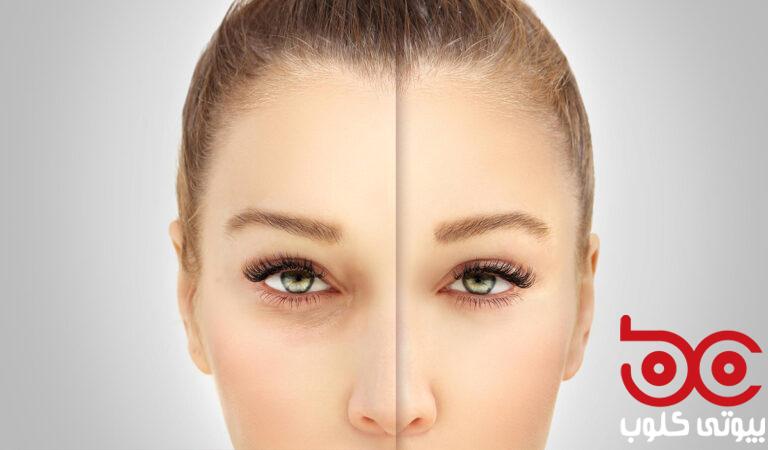 lower-blepharoplasty