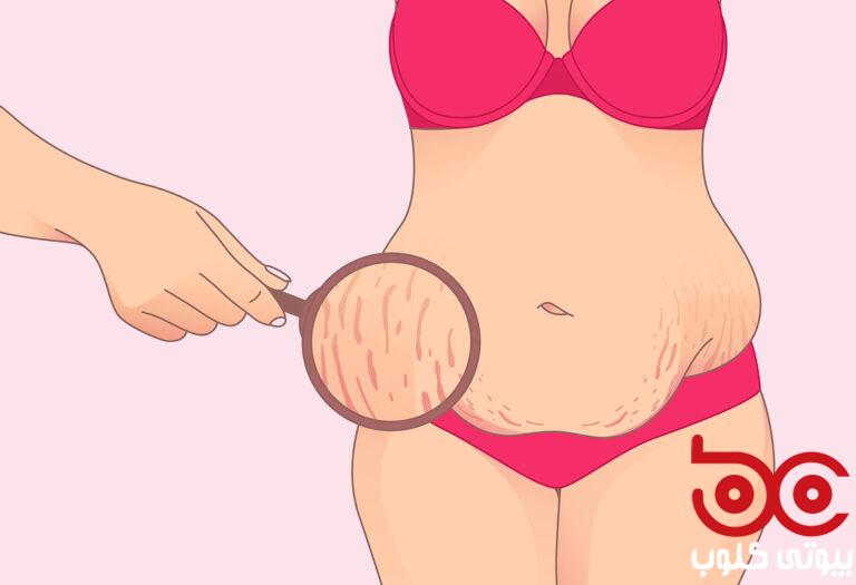 stretch-mark