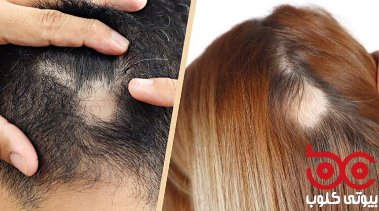 Coin-hair-loss