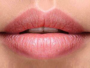 تزریق ژل لب مدل صدفی
