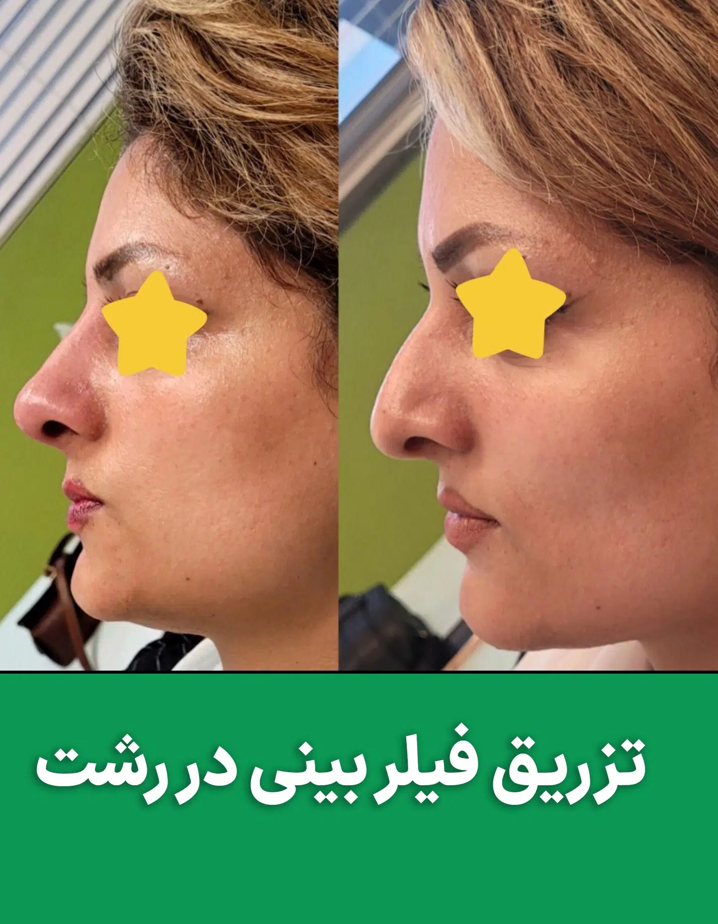 تزریق فیلر در رشت