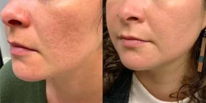 نمونه کارهای اگزوزم تراپی