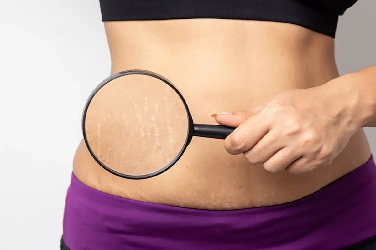استرچ مارک(stretch marks) چیست؟