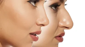 فیلر بینی