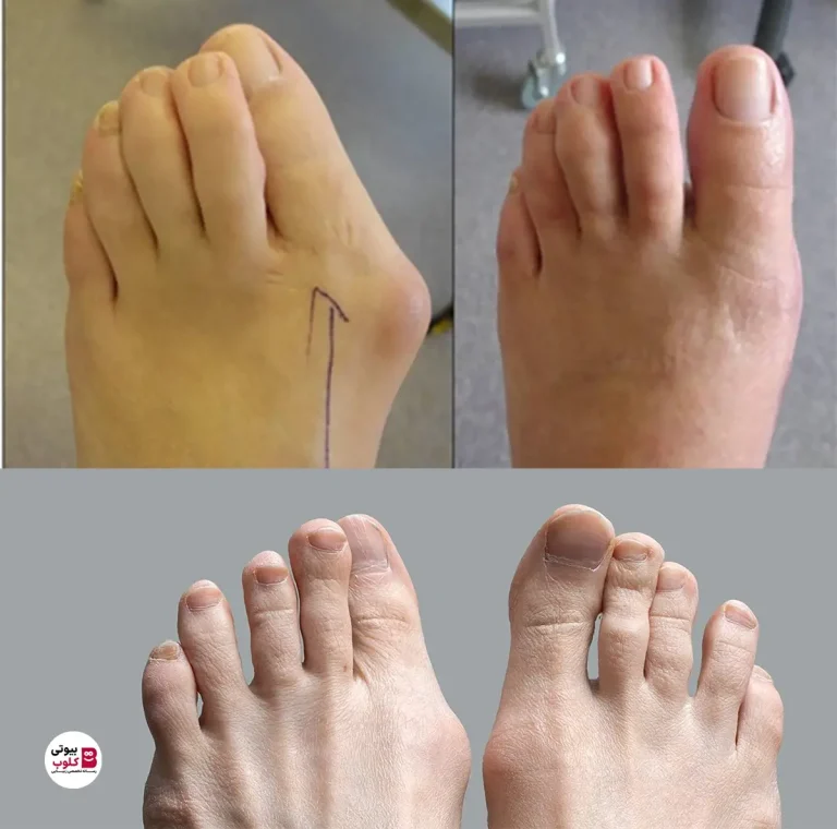 زیبایی پاها و هالوکس والگوس