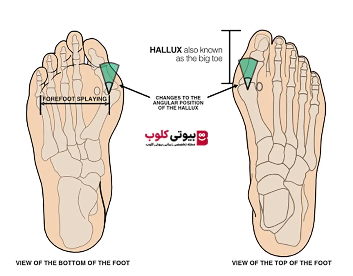 زیبایی پاها و هالوکس والگوس