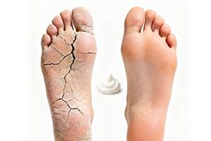 ترمیم پاشنه در ۷۲ ساعت | بهترین کرم ترک پا ایرانی