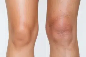 زیبایی زانو بدون جراحی