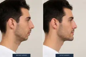 چه افرادی به جراحی فک نیاز دارند