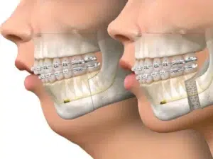 چه افرادی به جراحی فک نیاز دارند