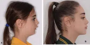 چه افرادی به جراحی فک نیاز دارند