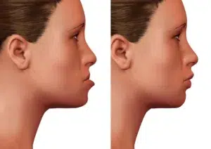 چه افرادی به جراحی فک نیاز دارند
