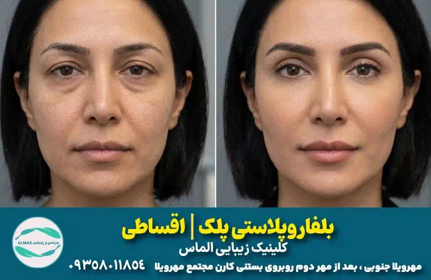 جراحی پلک اقساطی در کرج