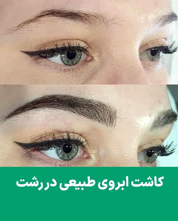 کاشت ابرو در شهر رشت