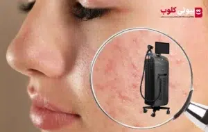 راهنمای طلایی لیزر موهای زائد