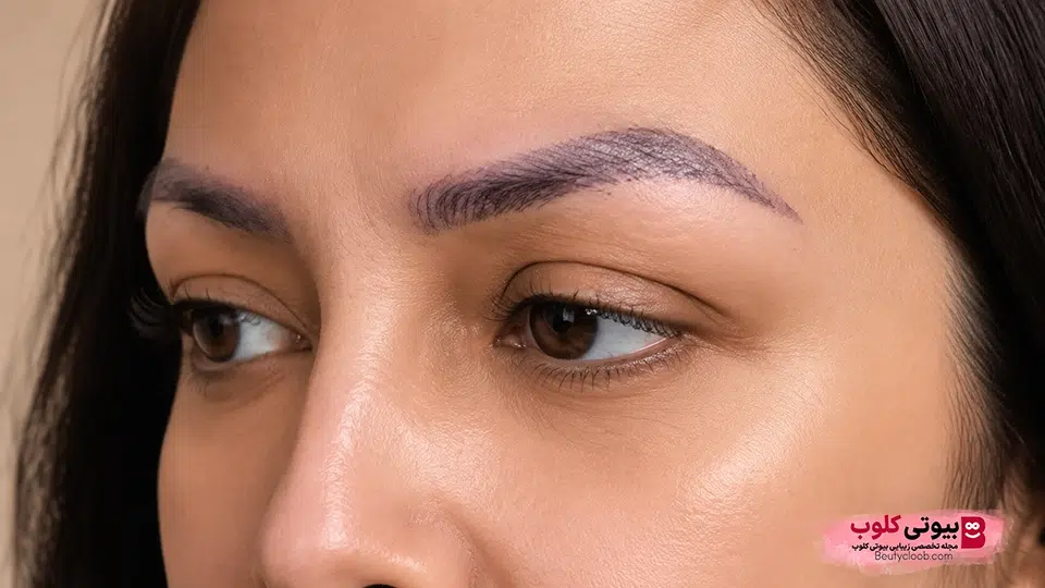کاشت ابرو به روش برداشت واحد فولیکولی