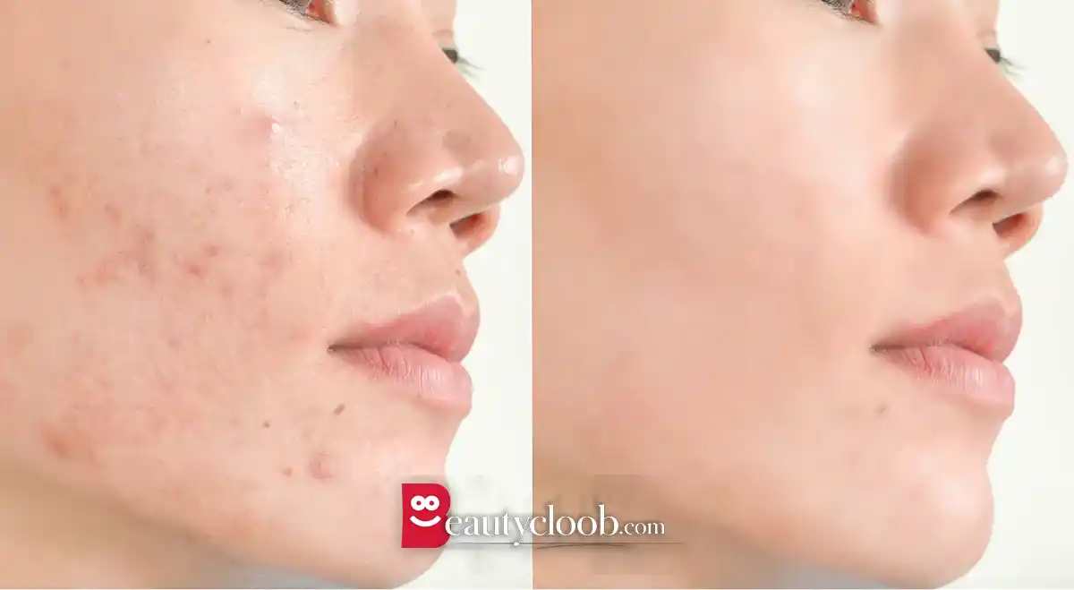 میکروتوکسین برای جوش