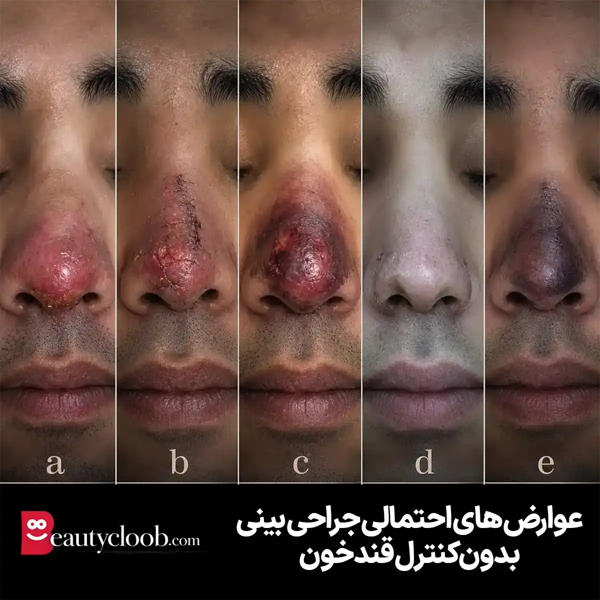 رینوپلاستی در دیابتیها