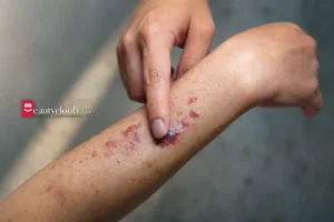 درمان آگلوتینین سرد